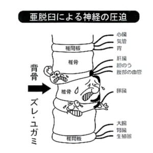 背骨での神経圧迫