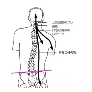 骨盤と背骨の歪み