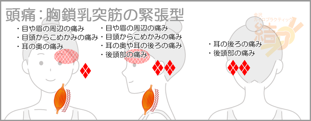 頭痛:胸鎖乳突筋の緊張型