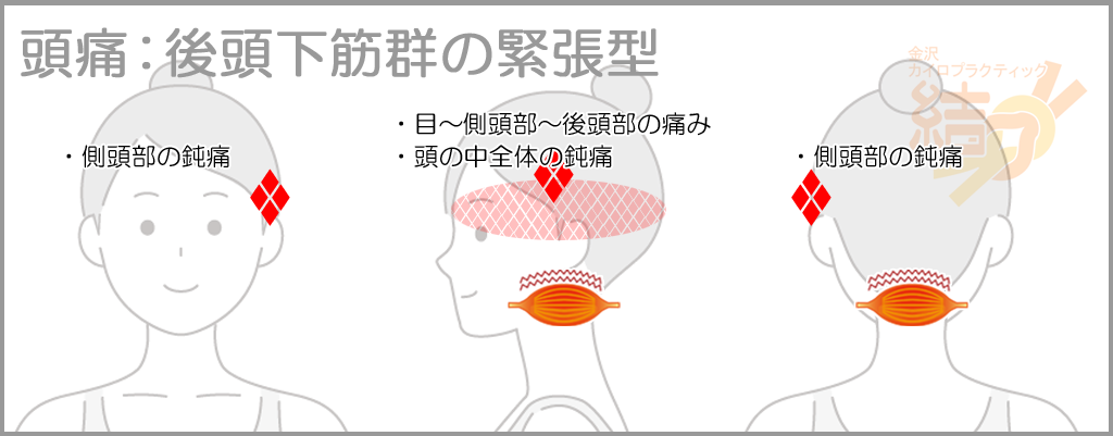 頭痛:後頭下筋群の緊張型