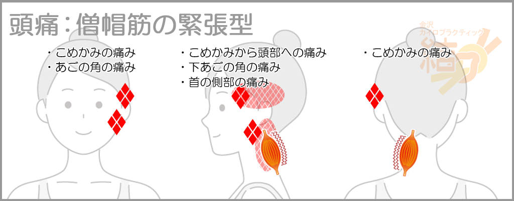 頭痛:僧帽筋の緊張型