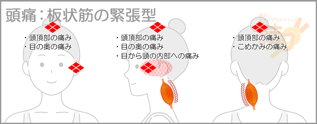 頭痛:板状筋の緊張型